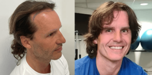 voor en na haartransplantatie