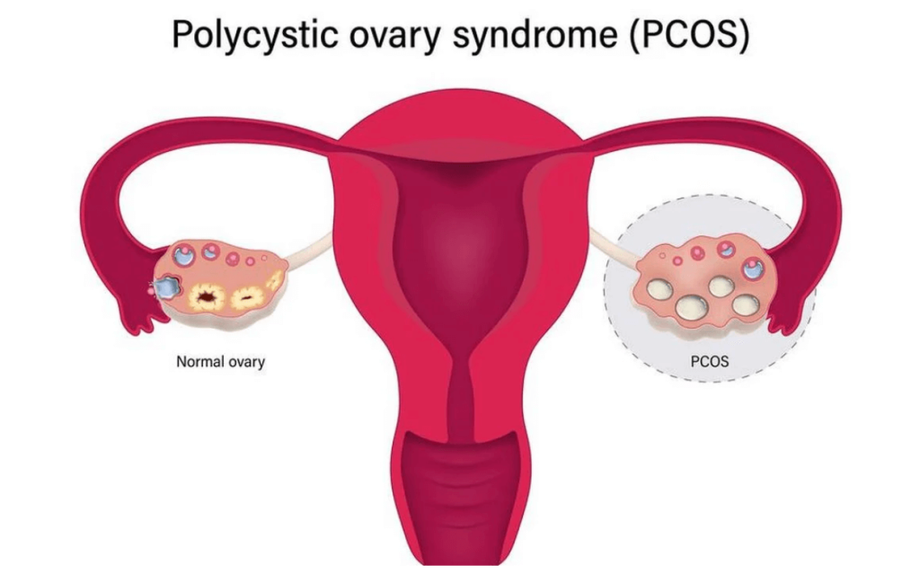 lean pcos