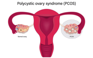 lean pcos